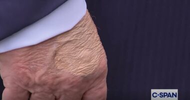 Fears for Donald Trump's health after eagle-eyed Americans spot mysterious markings across his body... as experts reveal what's wrong with him