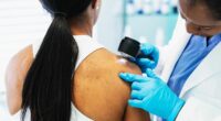 Five crucial signs your mole might be a melanoma, oncologist tells Dr Hilary