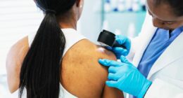 Five crucial signs your mole might be a melanoma, oncologist tells Dr Hilary