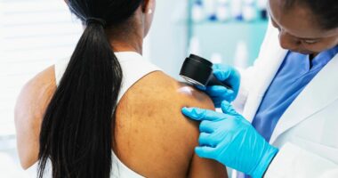 Five crucial signs your mole might be a melanoma, oncologist tells Dr Hilary