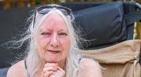 I fell asleep in the sun for 15 minutes and woke up in agony with my face disfigured