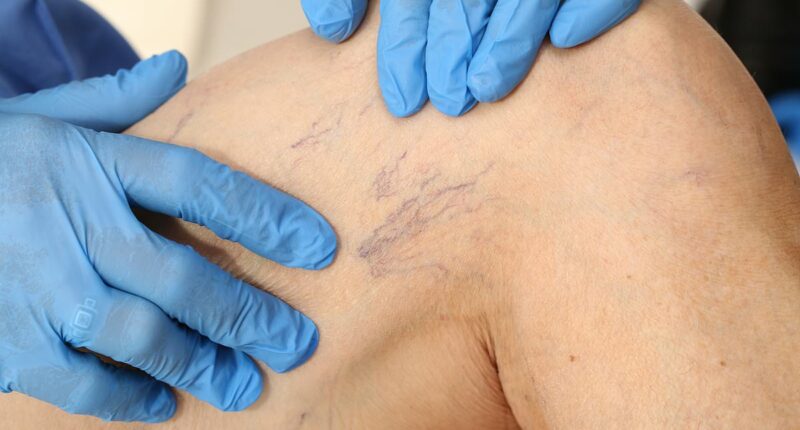 I hate the ugly veins in my legs... is there a way to get rid of them? DR ELLIE reveals the treatments available - and the simple seating position that can help