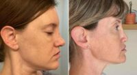 I spent $10K on a nose job...and woke up with part of my face missing
