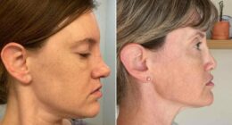 I spent $10K on a nose job...and woke up with part of my face missing