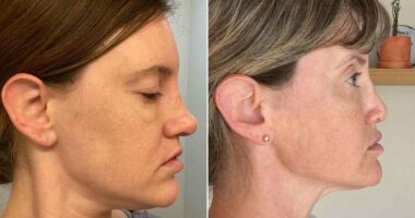 I spent $10K on a nose job...and woke up with part of my face missing