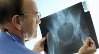 More than 100 NHS doctors warn Wes Streeting to honour promise to roll out screening clinics for osteoporosis - or risk thousands of ­preventable deaths