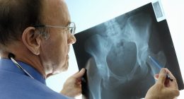 More than 100 NHS doctors warn Wes Streeting to honour promise to roll out screening clinics for osteoporosis - or risk thousands of ­preventable deaths