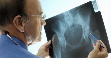 More than 100 NHS doctors warn Wes Streeting to honour promise to roll out screening clinics for osteoporosis - or risk thousands of ­preventable deaths