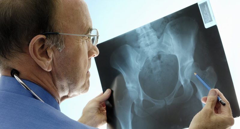 More than 100 NHS doctors warn Wes Streeting to honour promise to roll out screening clinics for osteoporosis - or risk thousands of ­preventable deaths