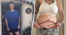 Mum lost 11st with Mounjaro - now she 'struggles to look at herself naked'
