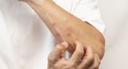 Stop insects from biting you by applying the 'CLOAK' trick