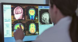 Two cancer drugs may reverse Alzheimer's brain changes — full study explained