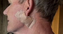 Gordon Ramsay reveals skin cancer scare