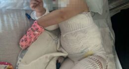 One-year-old girl with severe burns, hospitalized.