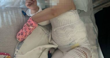 One-year-old girl with severe burns, hospitalized.