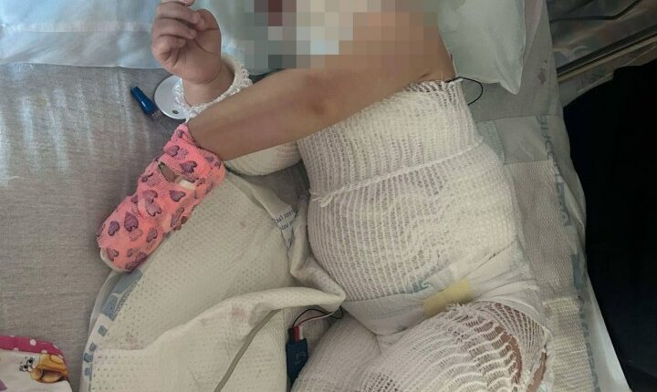 One-year-old girl with severe burns, hospitalized.