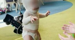 Baby Luka has undergone eight surgeries since the burning coffee was thrown on him.