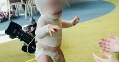 Baby Luka has undergone eight surgeries since the burning coffee was thrown on him.