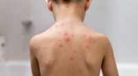 Millions of children set to get 'life saver' free chickenpox JAB - but could an NHS scheme to jab babies backfire? And is YOUR child eligible? Everything you need to know