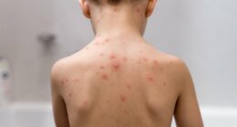 Millions of children set to get 'life saver' free chickenpox JAB - but could an NHS scheme to jab babies backfire? And is YOUR child eligible? Everything you need to know
