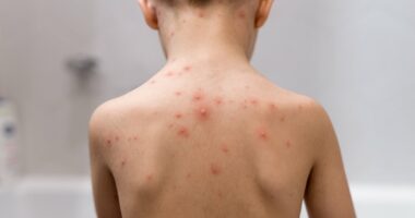 Millions of children set to get 'life saver' free chickenpox JAB - but could an NHS scheme to jab babies backfire? And is YOUR child eligible? Everything you need to know