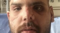Man with severe facial injuries from a grizzly bear attack.