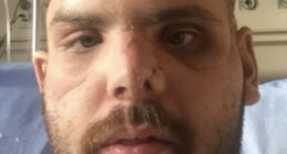 Man with severe facial injuries from a grizzly bear attack.