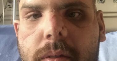 Man with severe facial injuries from a grizzly bear attack.