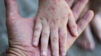 New York preparing for outbreak of SECOND 'highly contagious' virus