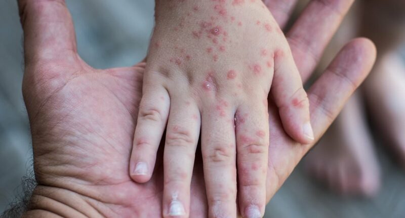 New York preparing for outbreak of SECOND 'highly contagious' virus