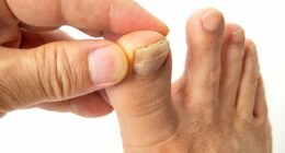 This is EXACTLY how to fix your crusty, yellow and thickened toenails - and how to tell if they're a sign of something more sinister, by Harley Street podiatrist STEVEN THOMAS