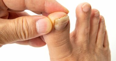 This is EXACTLY how to fix your crusty, yellow and thickened toenails - and how to tell if they're a sign of something more sinister, by Harley Street podiatrist STEVEN THOMAS