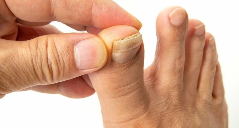 This is EXACTLY how to fix your crusty, yellow and thickened toenails - and how to tell if they're a sign of something more sinister, by Harley Street podiatrist STEVEN THOMAS