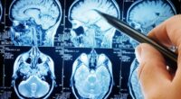 Trigger behind aggressive brain cancer uncovered - hope for prevention