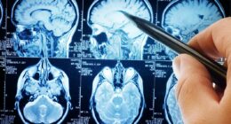 Trigger behind aggressive brain cancer uncovered - hope for prevention