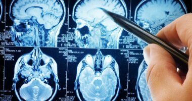 Trigger behind aggressive brain cancer uncovered - hope for prevention