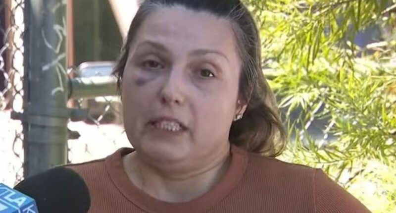 Woman with a black eye being interviewed.