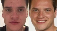 'My nan cured my acne in four days with a surprise cream'