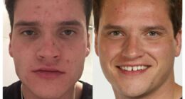 'My nan cured my acne in four days with a surprise cream'