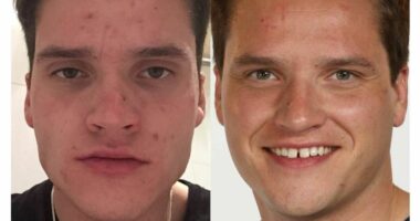 'My nan cured my acne in four days with a surprise cream'