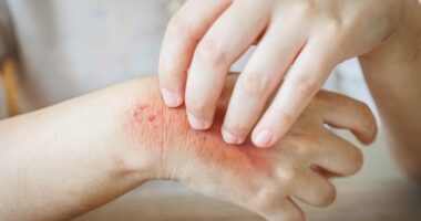 California outbreak of flea-borne typhus infections investigated