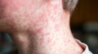 Cases of the world's most infectious disease keep climbing in the UK - with two major areas most at risk