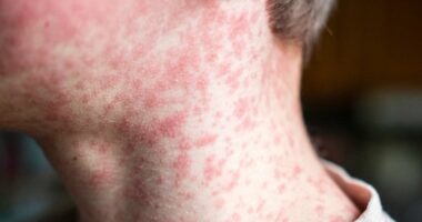 Cases of the world's most infectious disease keep climbing in the UK - with two major areas most at risk
