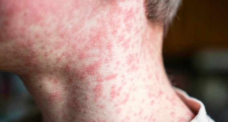 Cases of the world's most infectious disease keep climbing in the UK - with two major areas most at risk