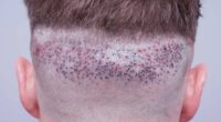 Hair transplant experts issue warning about UK clinics leaving men disfigured and depressed: 'Worse than Turkey'