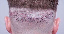 Hair transplant experts issue warning about UK clinics leaving men disfigured and depressed: 'Worse than Turkey'