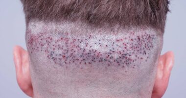 Hair transplant experts issue warning about UK clinics leaving men disfigured and depressed: 'Worse than Turkey'
