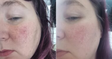 I tried cream that promised to reduce redness — it actually did something else