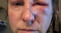 Mother-of-four, 43, reveals subtle mark she thought was just dry skin - but it was skin cancer: 'I ALWAYS wore sunscreen'