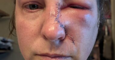 Mother-of-four, 43, reveals subtle mark she thought was just dry skin - but it was skin cancer: 'I ALWAYS wore sunscreen'